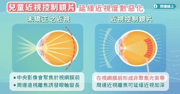 近視控制方法解析