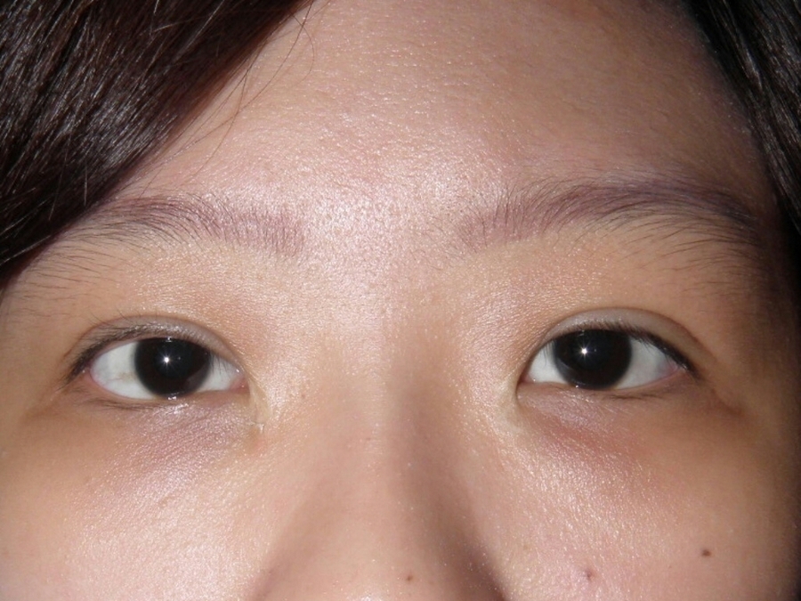 雙眼皮手術「眉角」很多？整外名醫林靜芸揭「動手術前必知7件事」