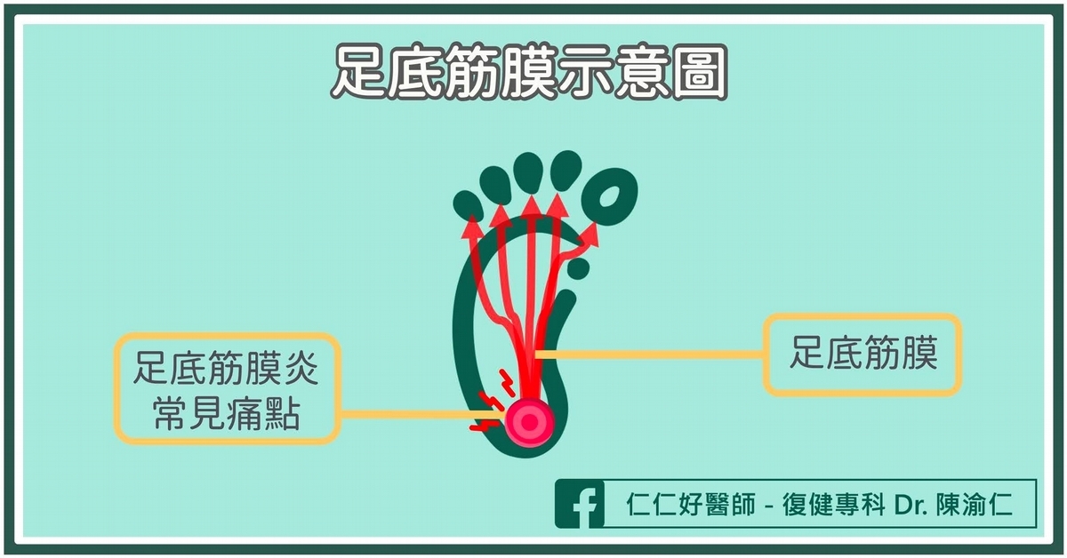 足底筋膜炎的典型症狀？