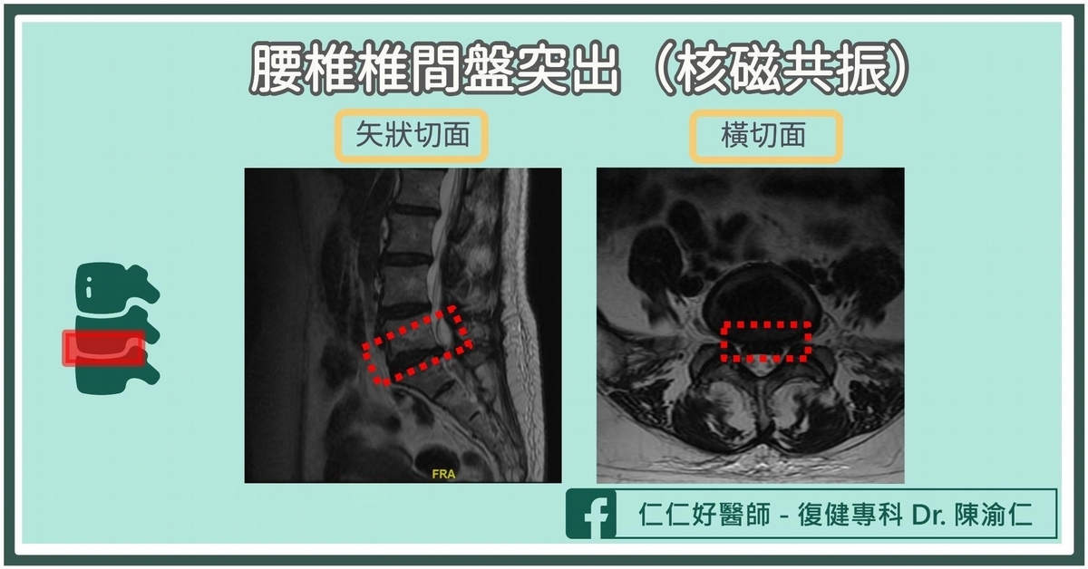 單車運動傷害2：脊椎