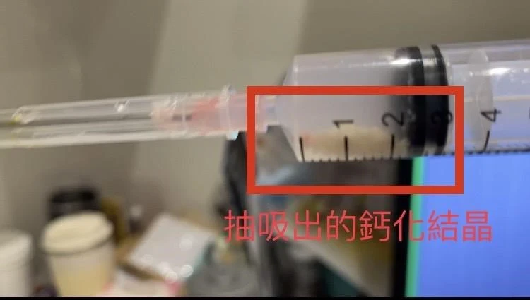 肩膀痛到睡不著⋯肌肉也會長石頭？醫教「1招」速測是否鈣化肌腱炎