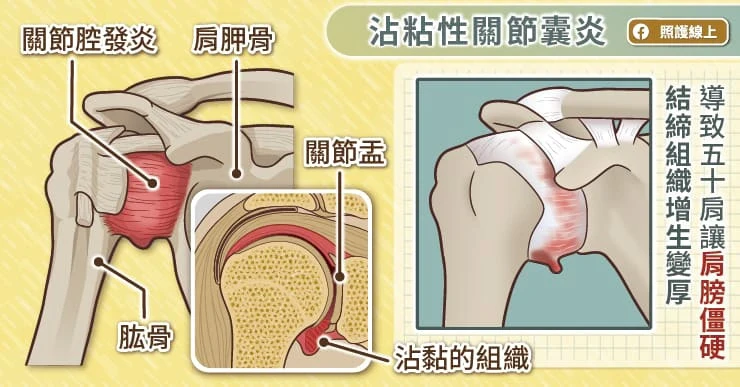 讓人肩膀僵硬的五十肩