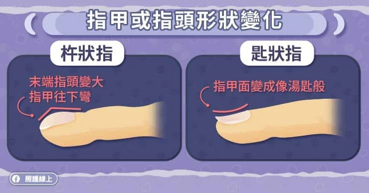 指甲或指頭形狀變化