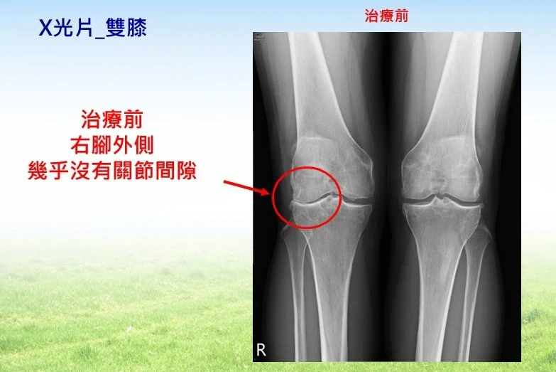 錢薇娟關節退化「軟骨重新長」