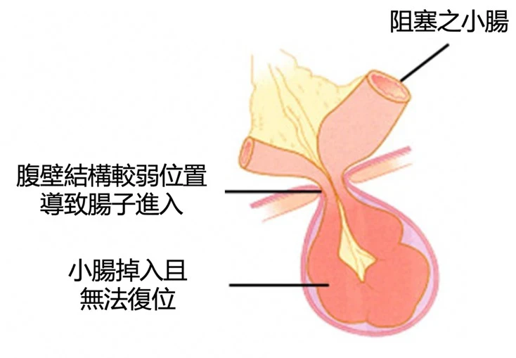 嘔吐、腹痛恐「疝氣合併腸阻塞」