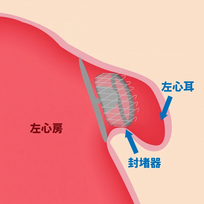 左心耳封堵手術防中風、出血