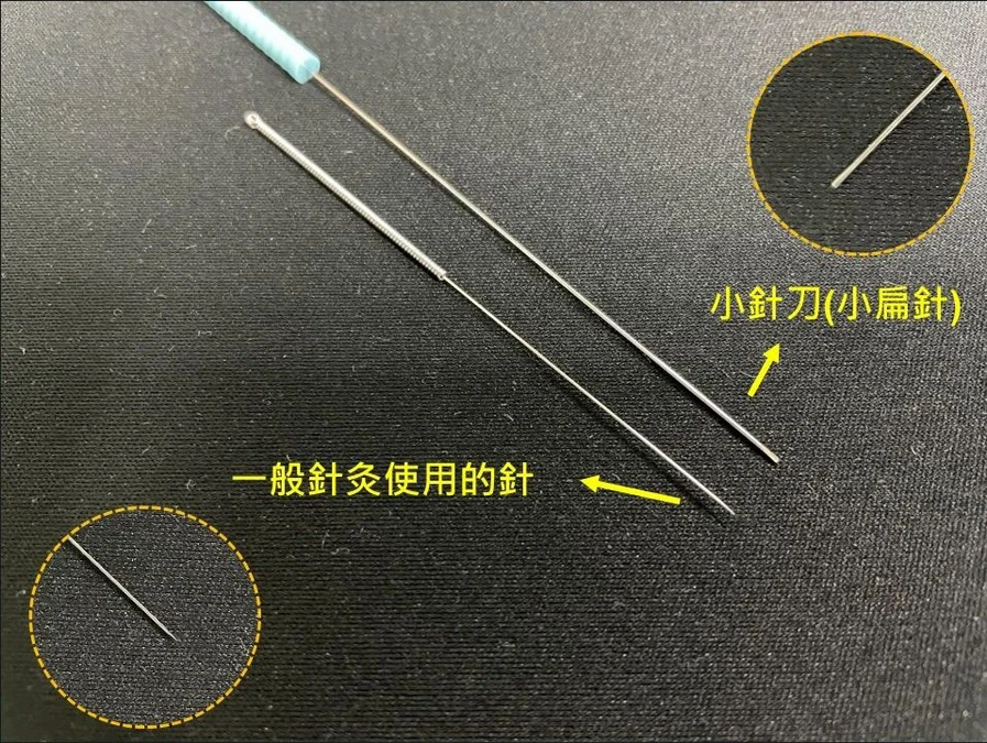 小扁針疏通氣血、活化關節