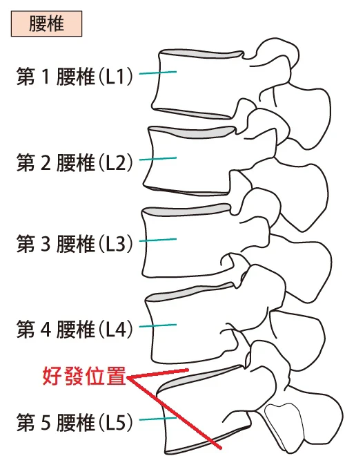 腰痠背痛又無力⋯我有椎間盤突出嗎？教你「1招」評估：抬腿就能測