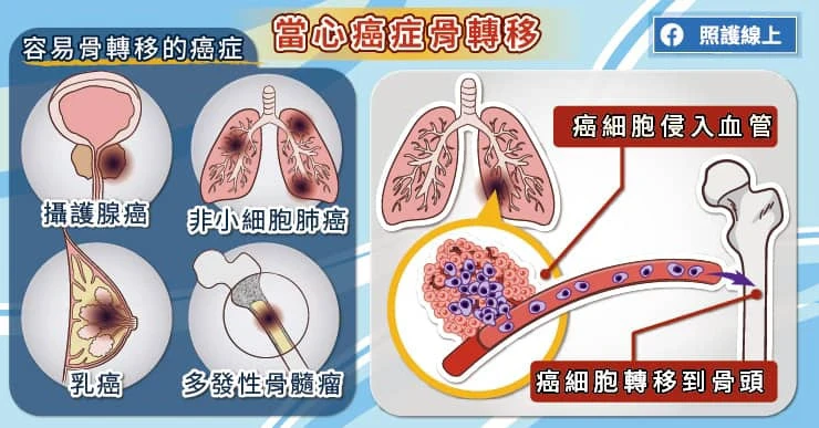 老翁坐著看報竟癱瘓，原來是肺癌轉移骨頭！醫解析「癌症骨轉移」症狀