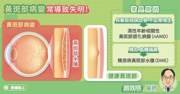 糖尿病黃斑部水腫 血糖過高導致