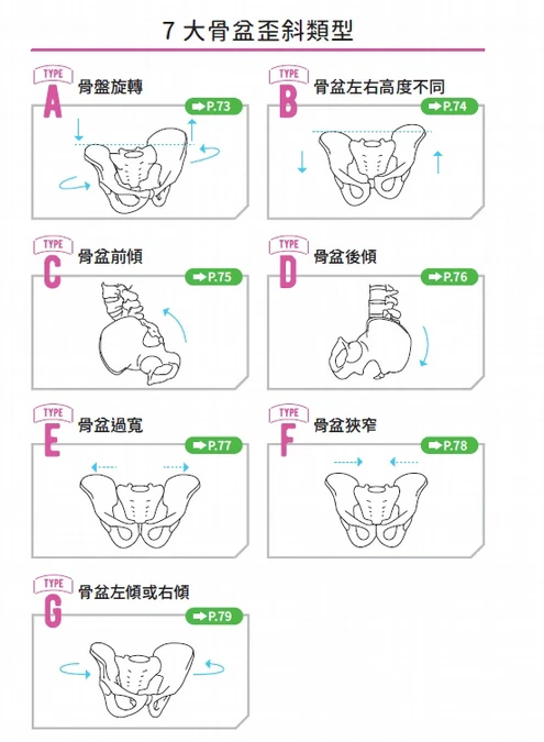 有圖解》我的骨盆歪斜了嗎？常見7大「骨盆歪斜類型」10秒自我檢測