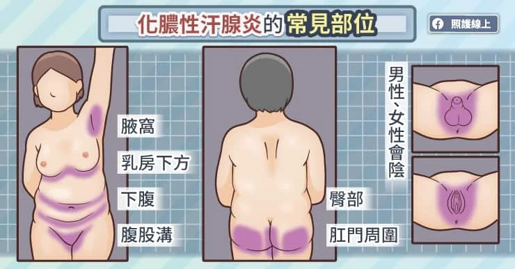 腋下狂長「大顆痘痘」腫痛流膿？小心「化膿性汗腺炎」2種人易中標