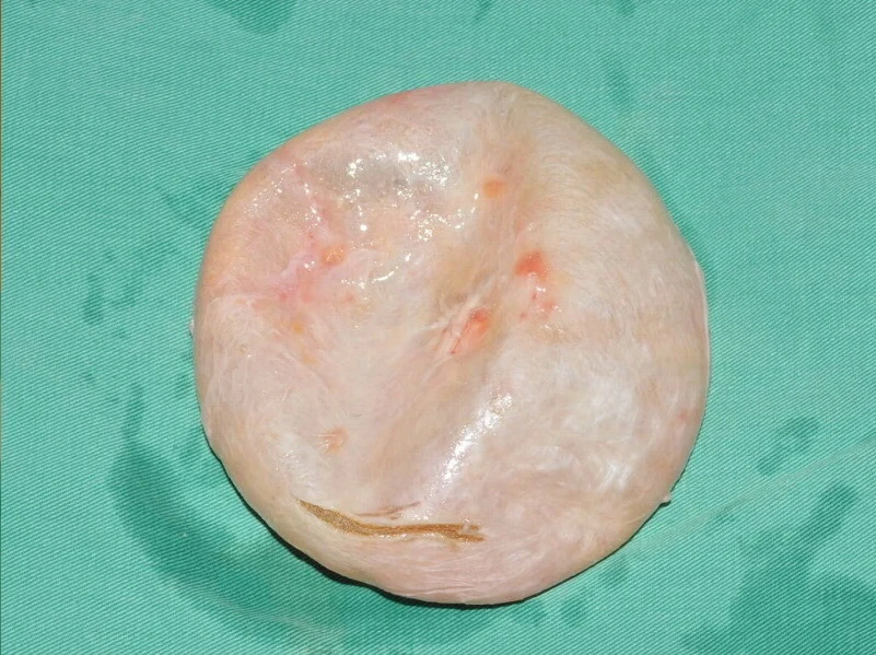 高低奶、石頭奶⋯隆乳「莢膜」須切除？林靜芸：「這類人」才要切除
