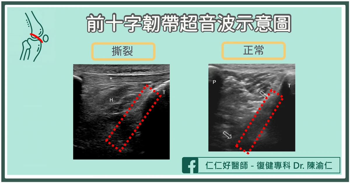 如何檢查前十字韌帶受傷?