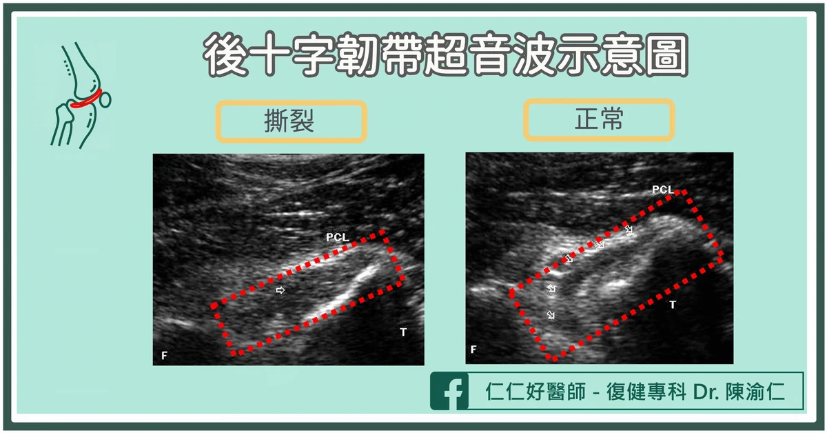 如何判斷後十字韌帶受傷?