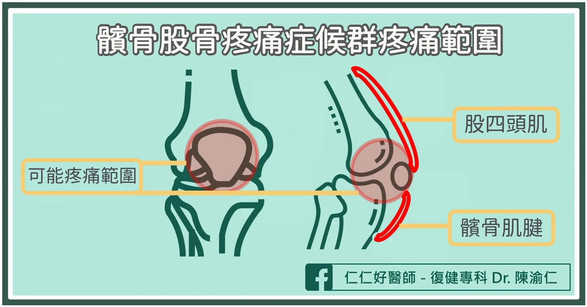 什麼是「髕骨股骨疼痛症候群」?
