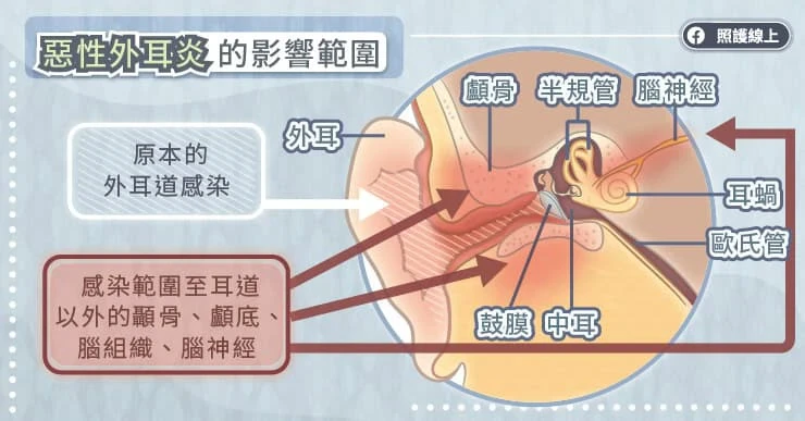 惡性外耳炎的影響範圍