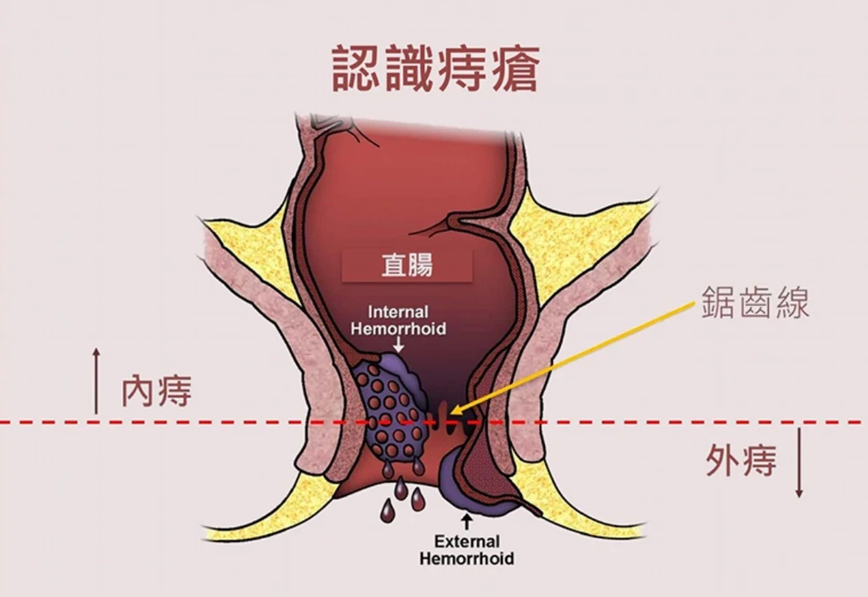 痔瘡內痔、外痣這樣分