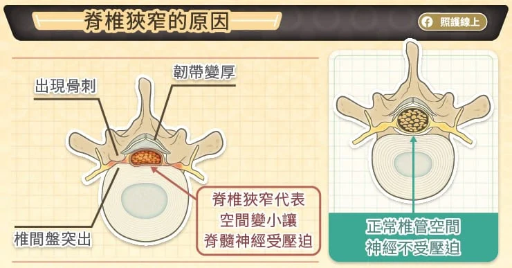 脊椎狹窄的原因