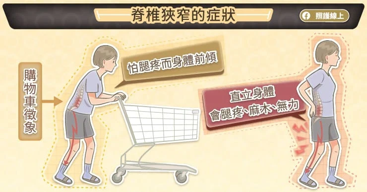 脊椎狹窄的症狀