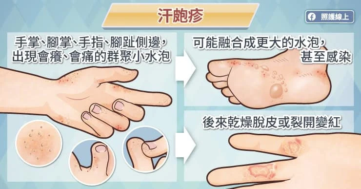  汗皰疹的症狀