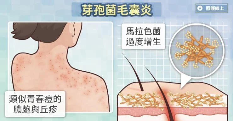 芽孢菌毛囊炎是什麼？