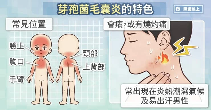 芽孢菌毛囊炎的症狀