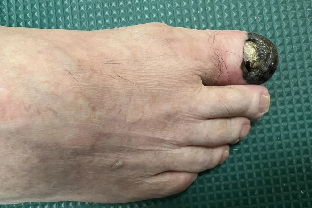 「肢端黑色素瘤」易被誤認瘀青