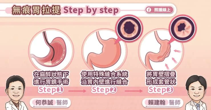 「無痕胃拉提」平均減15%體重