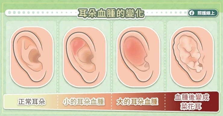  耳朵血腫恐致耳朵變形