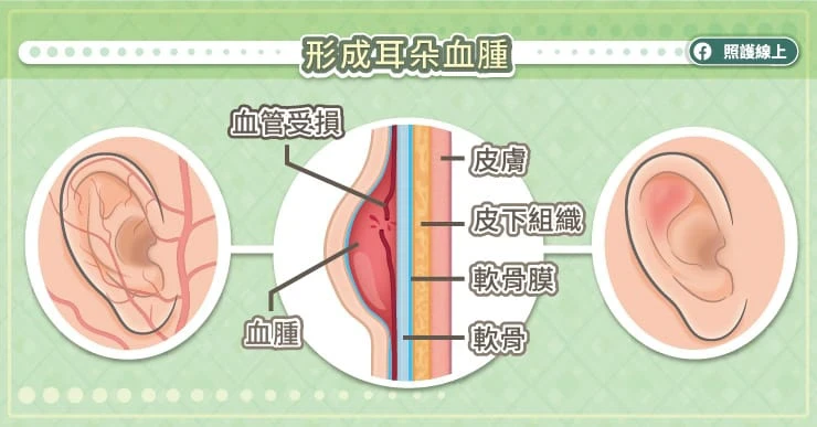  耳朵血腫聚積血塊