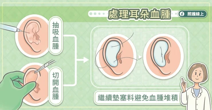 如何處理耳廓血腫