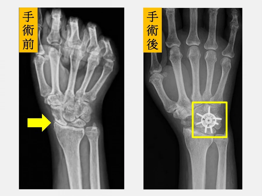 藥物、護具沒改善需手術