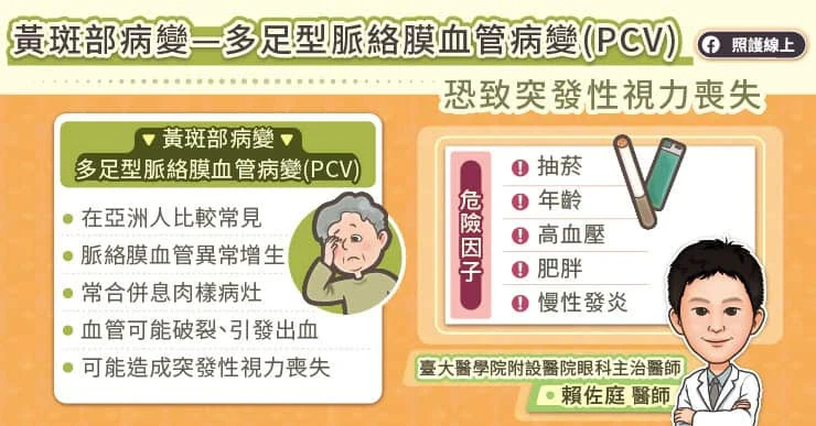 多足型脈絡膜血管病變是什麼?
