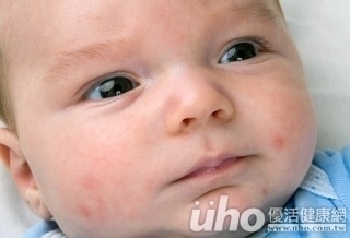 皮膚莫名冒紅點　新生兒患血小板低下症