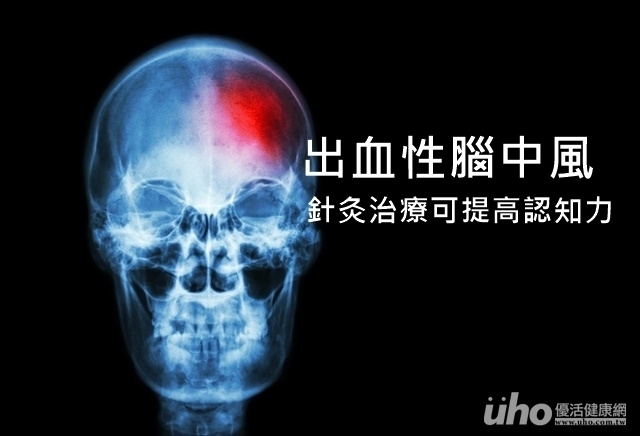 出血性腦中風　針灸治療可提高認知力