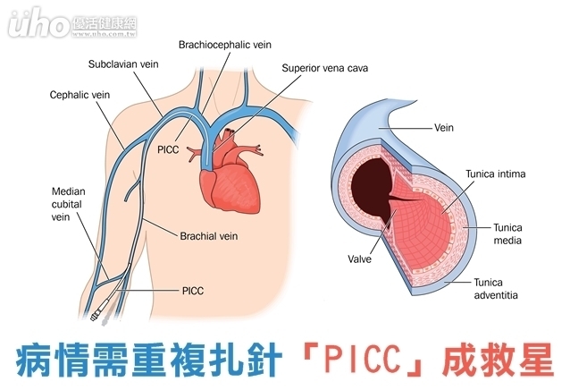 病情需重複扎針　「PICC」成救星