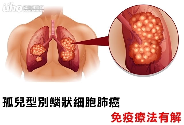 孤兒型別鱗狀細胞肺癌　免疫療法有解