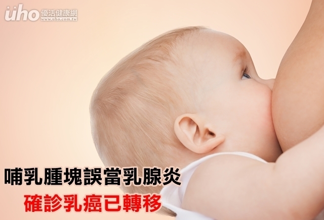 哺乳腫塊誤當乳腺炎　確診乳癌已轉移