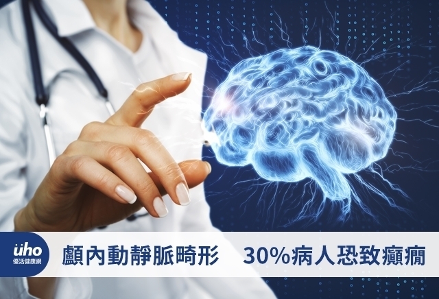 顱內動靜脈畸形　30%病人恐致癲癇