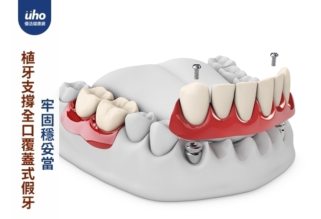 植牙支撐全口覆蓋式假牙　牢固穩妥當