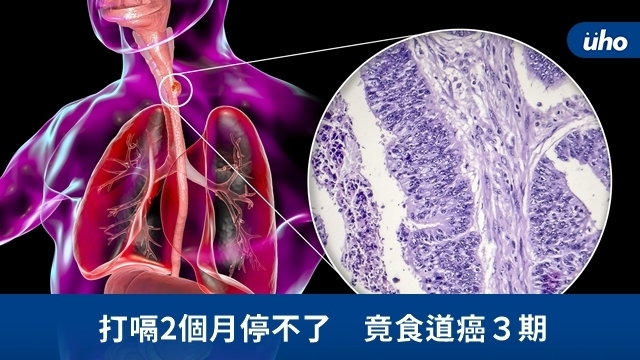 打嗝2個月停不了　竟食道癌３期