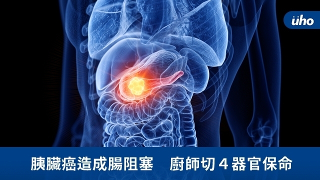 胰臟癌造成腸阻塞　廚師切４器官保命