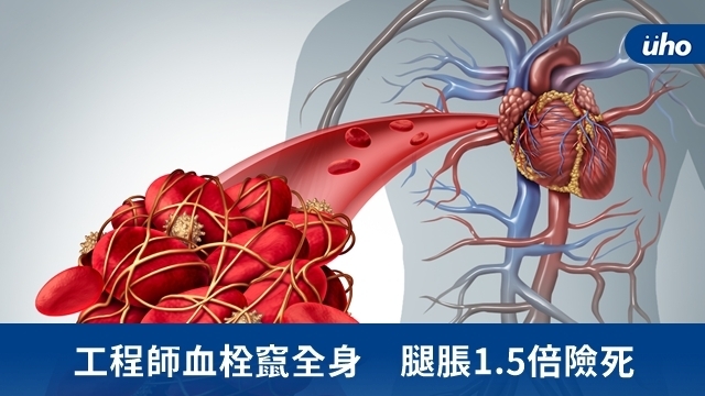 工程師血栓竄全身　腿脹1.5倍險死