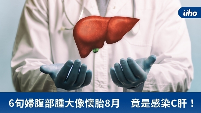 6旬婦腹部腫大像懷胎8月　竟是感染C肝！