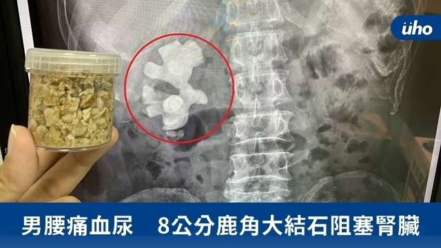 男腰痛血尿　8公分鹿角大結石阻塞腎臟