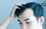禿頭用「養髮液」有效嗎？如何選購？皮膚醫揭「2指標」才有效果