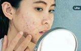 長痘痘是臉不乾淨，平常要多洗臉？中醫揭「1關鍵」千萬別過度清潔