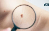 身上長痣是皮膚癌嗎？快速變大、凸起⋯當心「4類黑痣」恐長惡性腫瘤