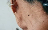 臉上長微凸的痣，竟然是皮膚癌？醫揪「基底細胞癌」好發於曝曬部位